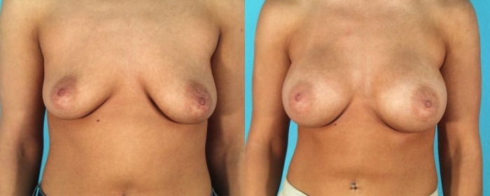 До и после силикона. Пластическая хирургия груди НЮ (9 фото)