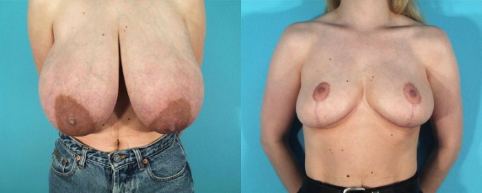 До и после силикона. Пластическая хирургия груди НЮ (9 фото)