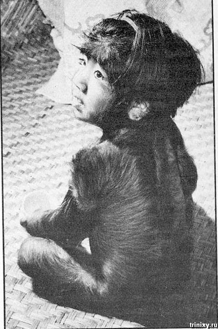 Самый волосатый человек в детстве (3 фото)