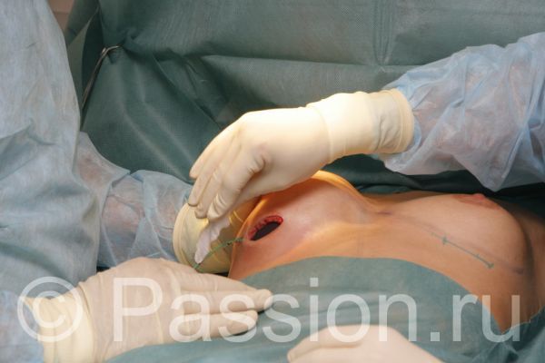 Операция по увеличению груди (26 фото) НЮ