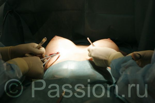 Операция по увеличению груди (26 фото) НЮ