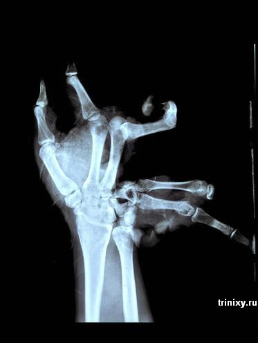 Рентгеновские снимки из травмпункта (12 фото)