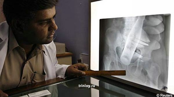 История одного рентгеновского снимка (2 фото)