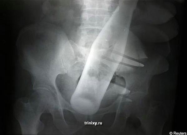 История одного рентгеновского снимка (2 фото)