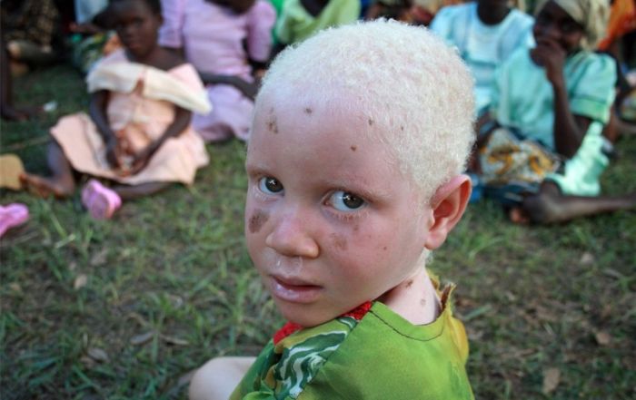 Африканские альбиносы (8 фото)