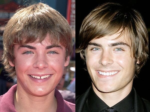 Улыбки знаменитостей. До и после (10 фото)