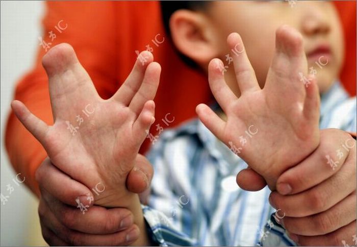Мальчик с 34 пальцами (13 фото)