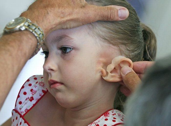 Новое ухо для маленькой девочки (12 фото)