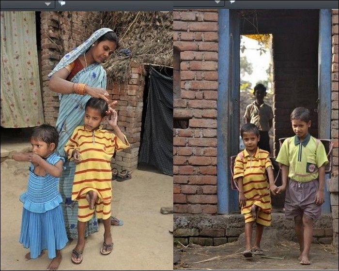 В Индии родилась девочка с головой в животе