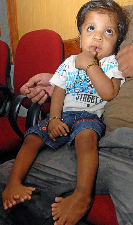 Индийский мальчик с 34-мя пальцами (4 фото)