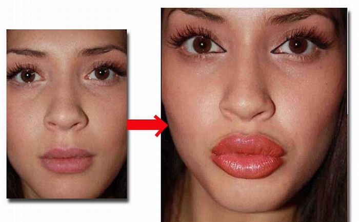 Фото «до и после» увеличения больших половых губ