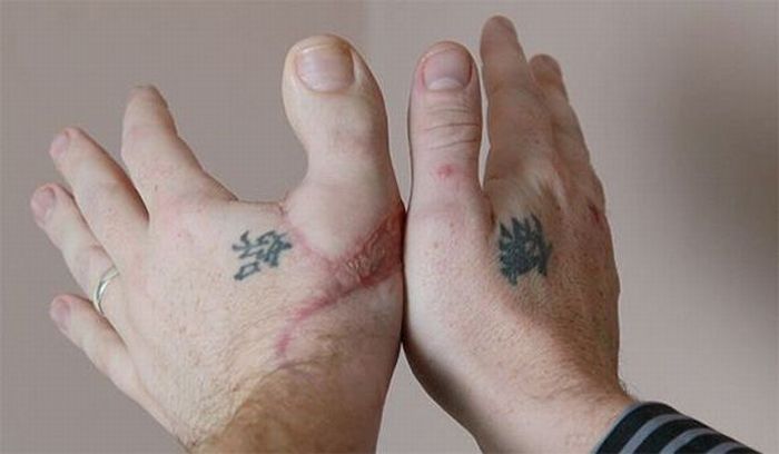 Пересаженный палец (3 фото)