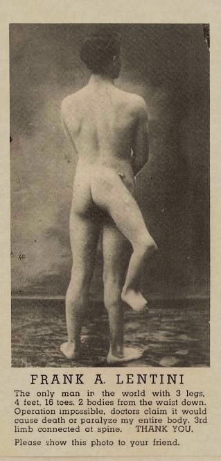 Франческо Лентини - человек с тремя ногами (5 фото)
