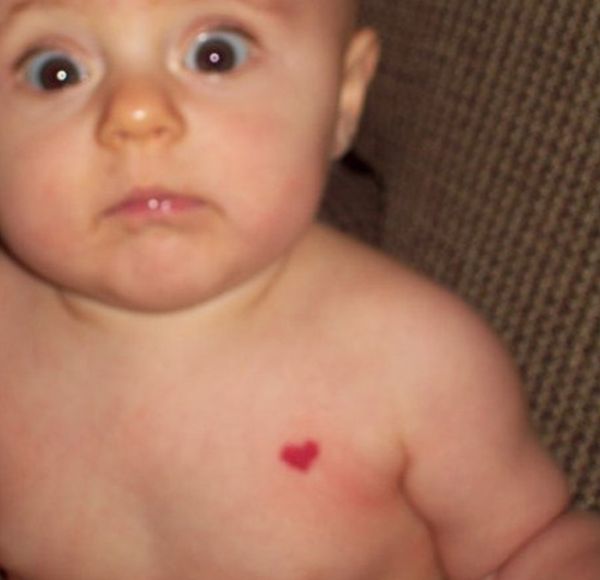 Ребенок с родимым пятном (3 фото)