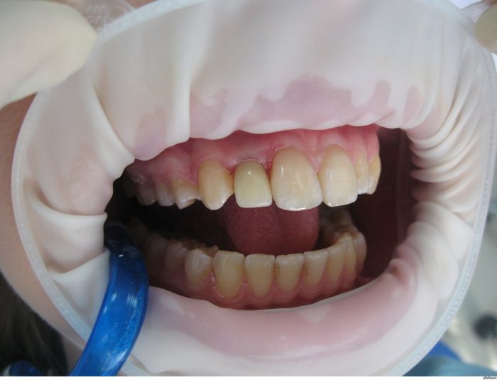 Установка зубного импланта (3 фото)