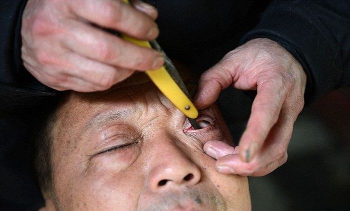 Китайская процедура "бритья" глаз (4 фото)