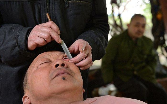 Китайская процедура "бритья" глаз (4 фото)