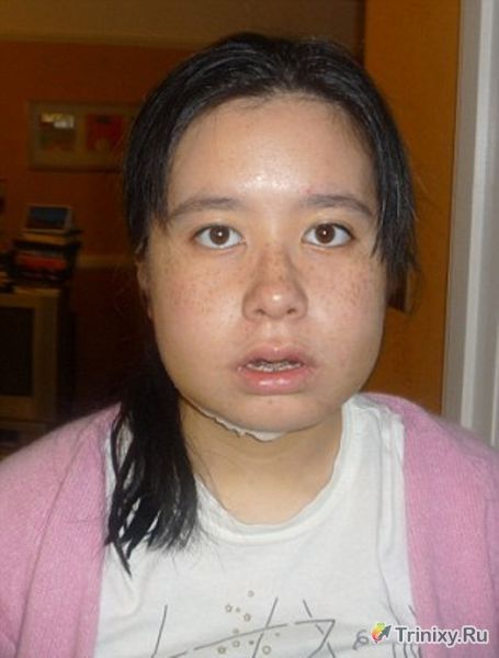 Как изменилась внешность девушки после ортогнатической операции (16 фото)