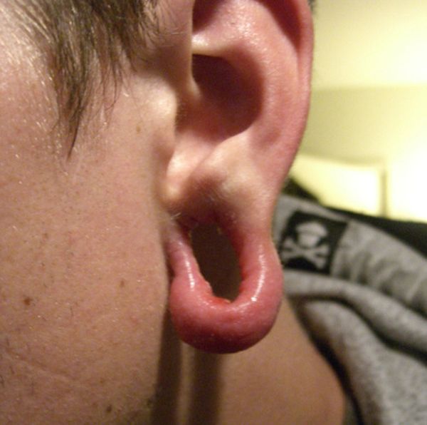 Последствия каналов в ушах (10 фото)