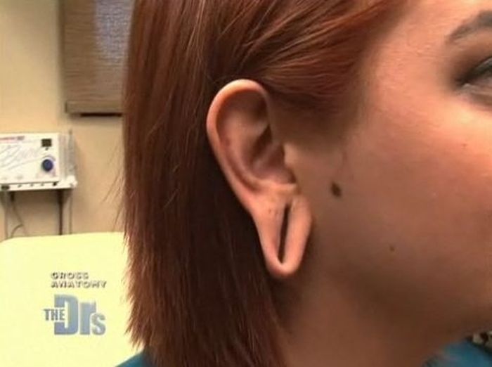 Последствия каналов в ушах (10 фото)
