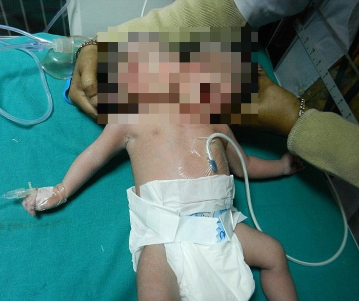 В Индии родился ребенок с двумя головами (3 фото)