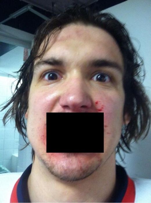 Прямое попадание хоккейной шайбы в лицо (2 фото)