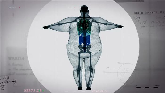 Рентгеновский снимок тела 400-килограммового мужчины (5 фото)