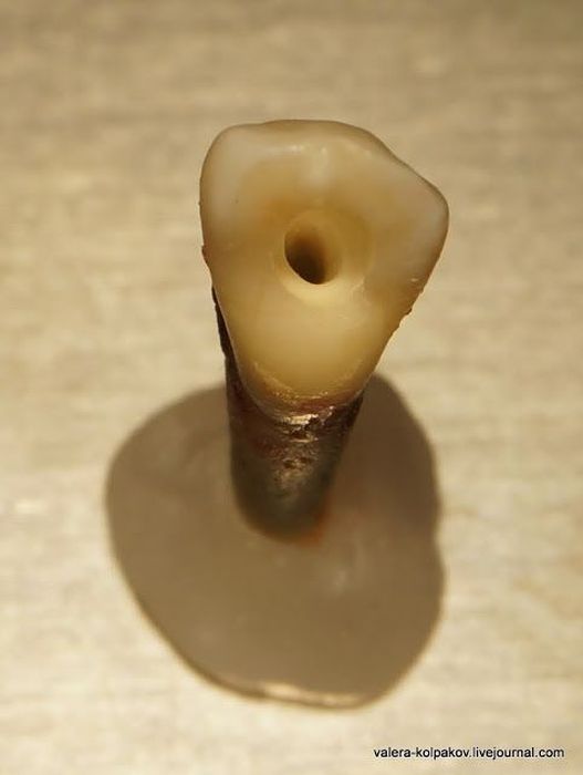 Как осуществляется пломбирование зубов и корневого канала (15 фото)