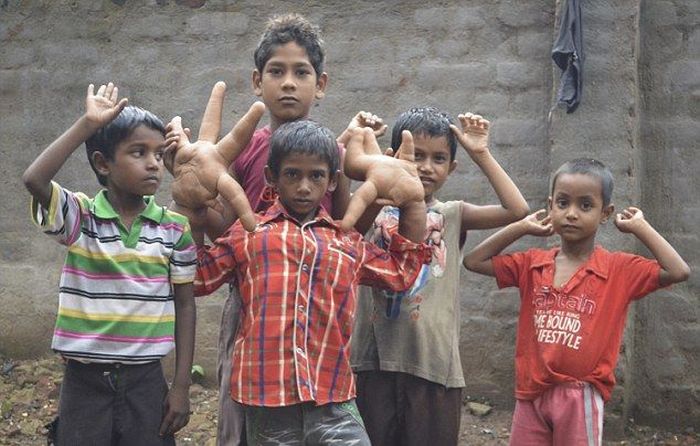 Индийский мальчик с гигантскими руками (17 фото)