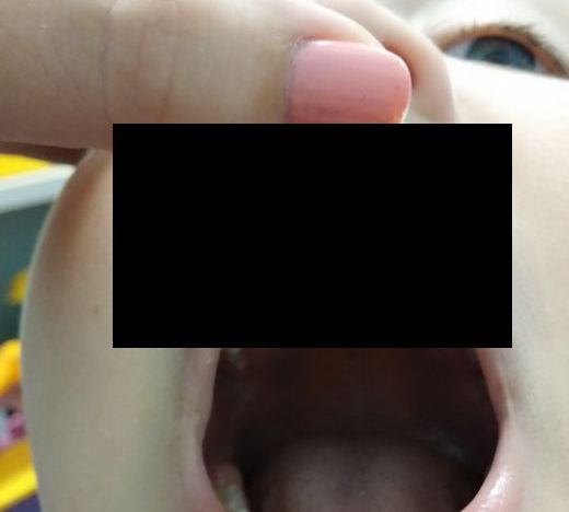 У малыша вырос лишний зуб в необычном месте (3 фото)