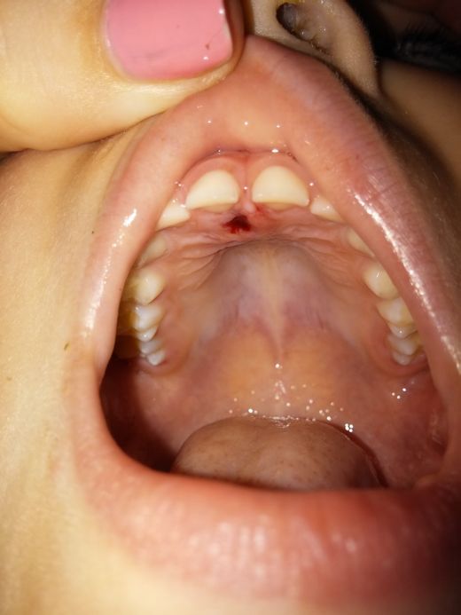 У малыша вырос лишний зуб в необычном месте (3 фото)