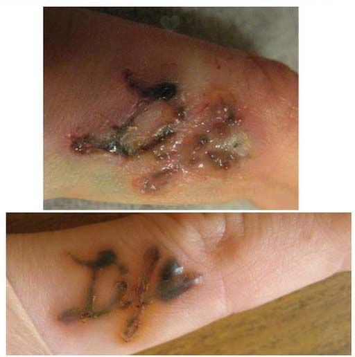 К чему приводит самостоятельное удаление татуировок (9 фото)