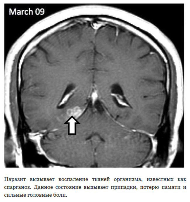 Паразитический червь 4 года блуждает по мозгу человека (5 фото)