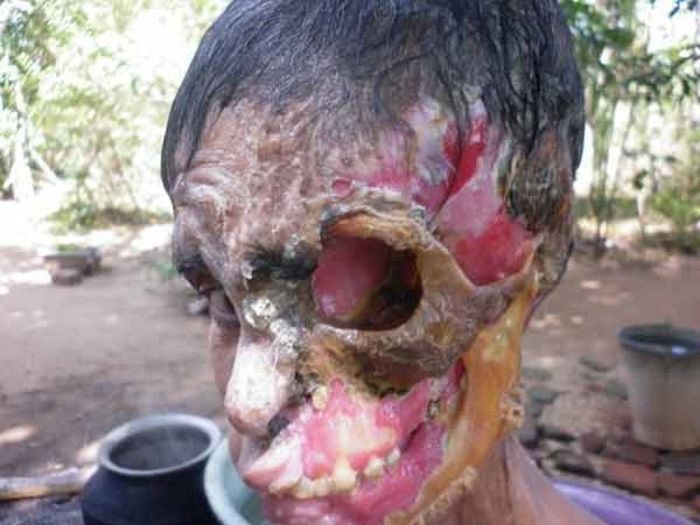 Некротический фасциит - болезнь стран третьего мира (10 фото)
