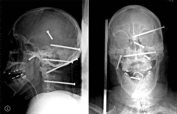 Необычные предметы в теле людей на рентгеновских снимках (37 фото)