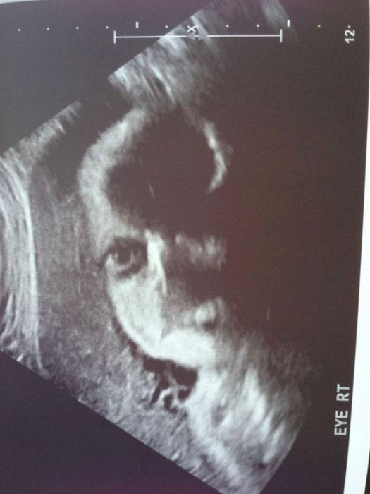 Как выглядят дети в утробе матери на экранах аппаратов УЗИ (13 фото)