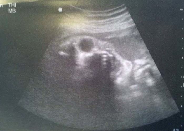 Как выглядят дети в утробе матери на экранах аппаратов УЗИ (13 фото)