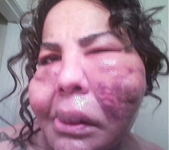 Изуродованная лжехирургом женщина-трансгендер Раджи Наринесинг обрела новое лицо (7 фото)