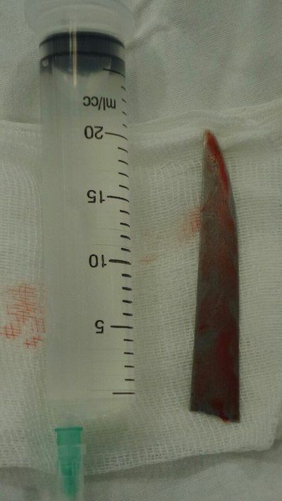 Мужик месяц прожил с ножом в нёбе (2 фото)