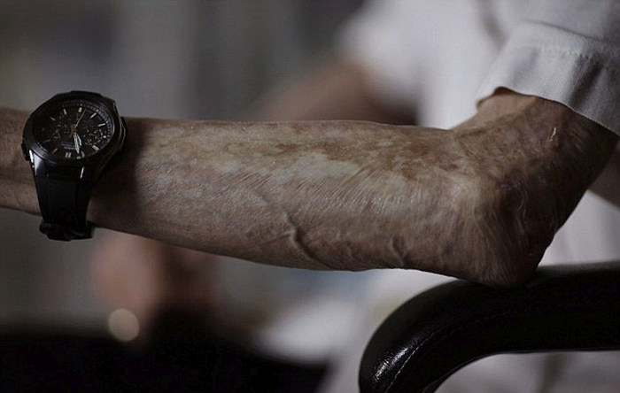 Последствия ядерного удара по Нагасаки на теле 86-летнего пенсионера (10 фото)