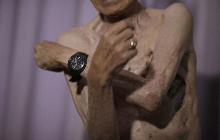 Последствия ядерного удара по Нагасаки на теле 86-летнего пенсионера (10 фото)