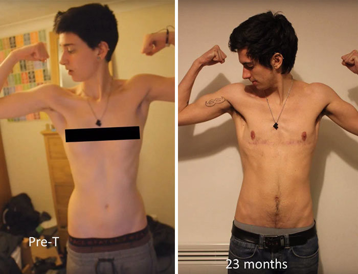 Трансгендеры фото органов до и после операции