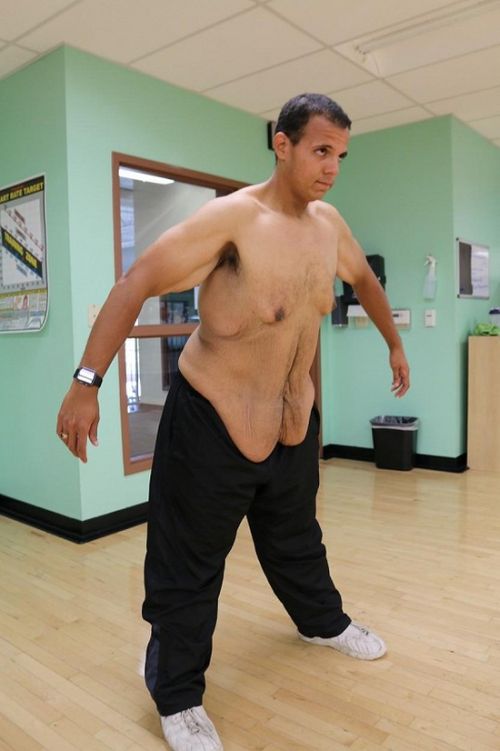 Американец похудел на 181 кг и столкнулся с проблемой лишней кожи (7 фото)