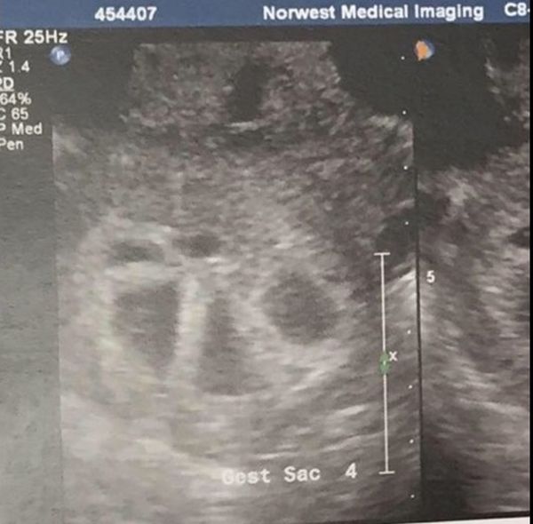Так выглядит женщина, беременная пятерняшками (6 фото)