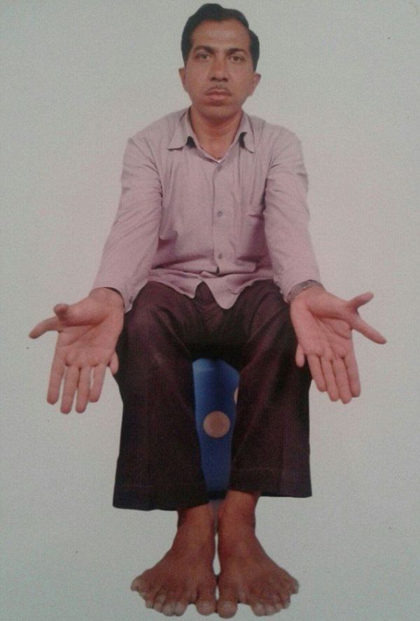 Девендра Сутхар - рекордсмен мира по количеству пальцев на руках и ногах (7 фото)