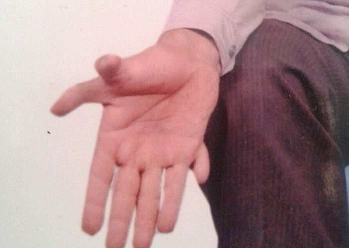 Девендра Сутхар - рекордсмен мира по количеству пальцев на руках и ногах (7 фото)