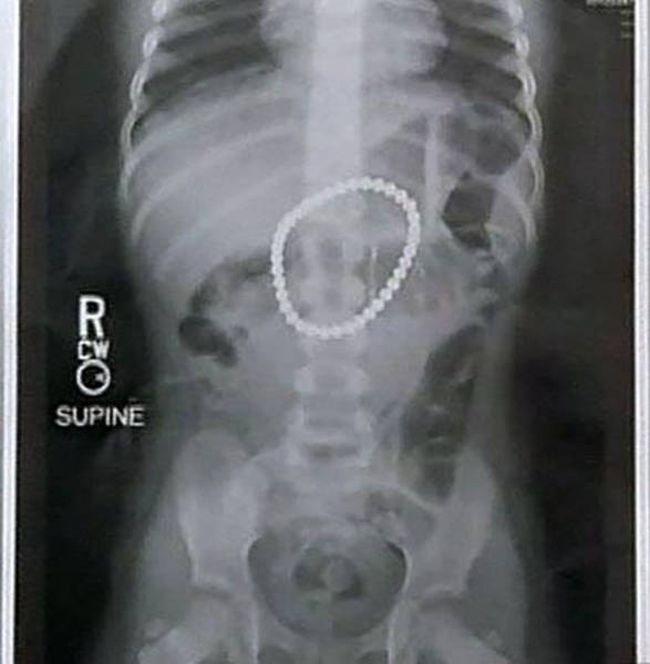 Неожиданные предметы, обнаруженные врачами внутри маленьких пациентов (6 фото)