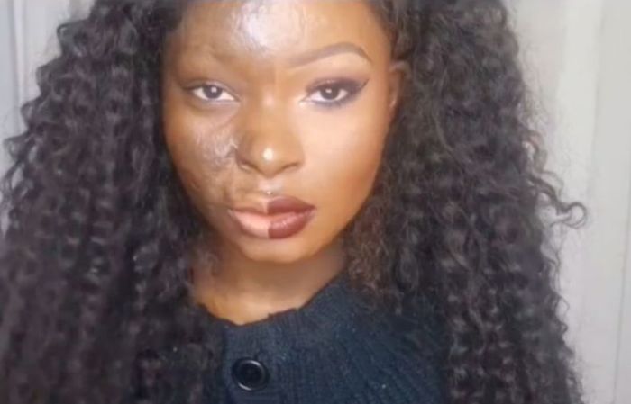 Девушка с сильными ожогами лица наглядно демонстрирует силу макияжа (8 фото + видео)