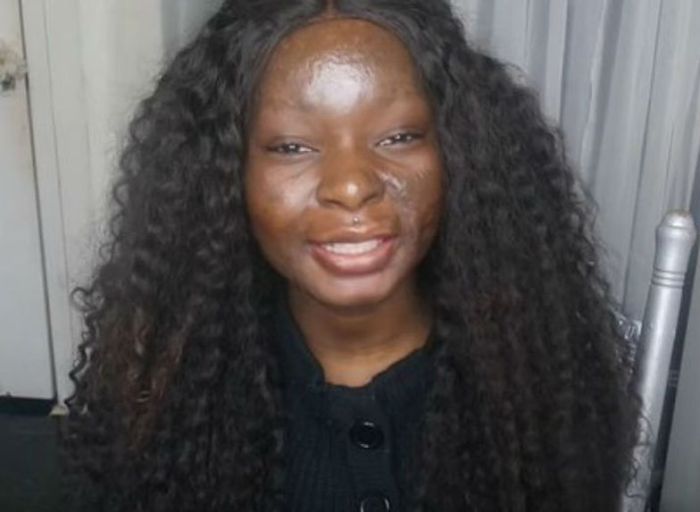 Девушка с сильными ожогами лица наглядно демонстрирует силу макияжа (8 фото + видео)
