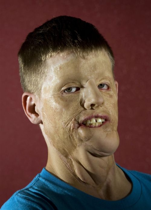 Американские медики вернули мужчине с изуродованным лицом человеческий облик (12 фото)